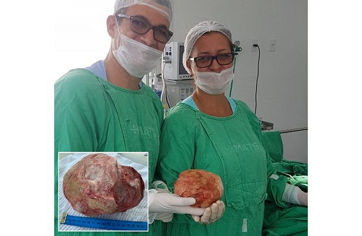 Lavrador de 51 anos tem pedra de 1,3 Kg e 18 cm retirada da bexiga em cirurgia na Bahia (Foto: Renan Oliveira Barreto) Lavrador de 51 anos tem pedra de 1,3 Kg e 18 cm retirada da bexiga em cirurgia na Bahia (Foto: Renan Oliveira Barreto)