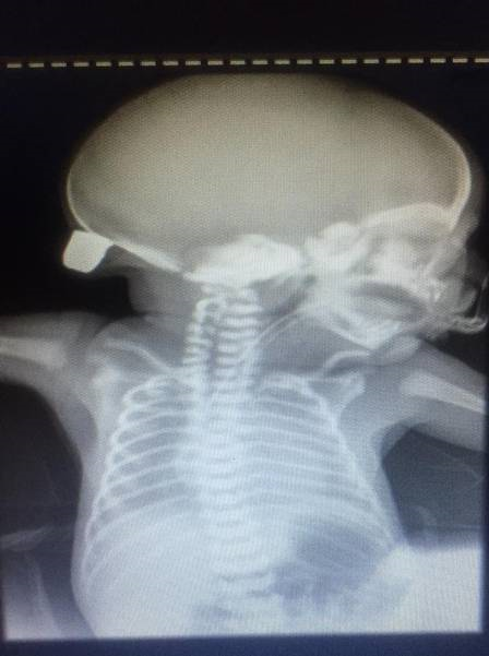 A radiografia do bebê mostra a bala alojada na cabeça (Foto: Reprodução) A radiografia do bebê mostra a bala alojada na cabeça (Foto: Reprodução)
