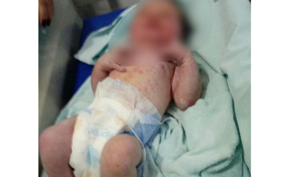 Bebê foi encontrado ao lado de um formigueiro com várias marcas de picadas de formiga espalhadas pelo corpo (Foto: Reprodução | Arquivo pessoal) Bebê foi encontrado ao lado de um formigueiro com várias marcas de picadas de formiga espalhadas pelo corpo (Foto: Reprodução | Arquivo pessoal)