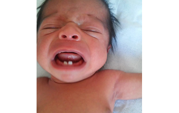 Com dez dias de nascido, o bebê passou pelo procedimento para extrair os dentes (Foto: Reprodução) Com dez dias de nascido, o bebê passou pelo procedimento para extrair os dentes (Foto: Reprodução)