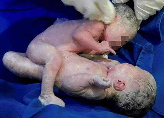 Unidas pelo abdômen, elas dividem fígado, rim, bexiga e órgão reprodutor (Foto: Reprodução) Unidas pelo abdômen, elas dividem fígado, rim, bexiga e órgão reprodutor (Foto: Reprodução)