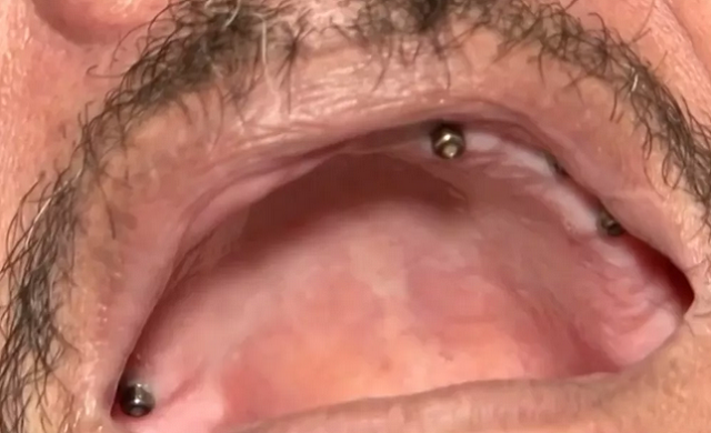 Homem teve nove dentes extraídos de uma só vez por falso dentista na Bahia (Foto: Reprodução | TV Santa Cruz) Homem teve nove dentes extraídos de uma só vez por falso dentista na Bahia (Foto: Reprodução | TV Santa Cruz)