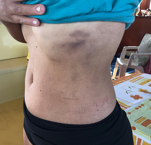 A instrutora de vela também foi agredida na costela (Foto: Divulgação) A instrutora de vela também foi agredida na costela (Foto: Divulgação)